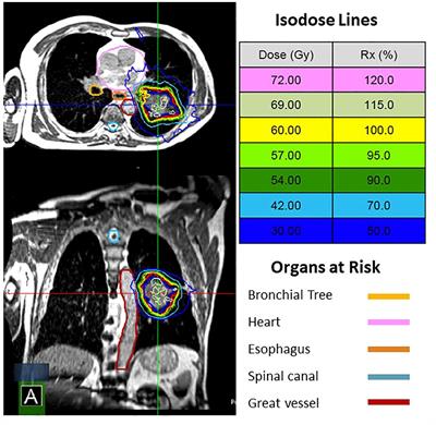 Single institution experience of MRI-guided radiotherapy for thoracic tumors and clinical characteristics impacting treatment duty cycle